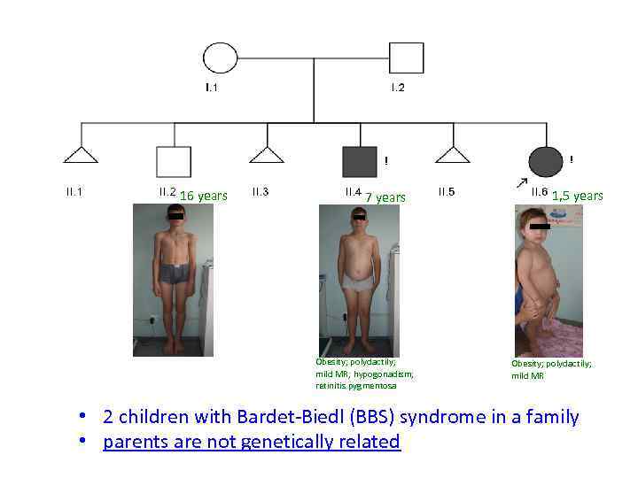 16 years 7 years Obesity; polydactily; mild MR; hypogonadism; retinitis pygmentosa 1, 5 years