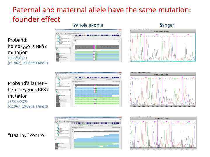 Paternal and maternal allele have the same mutation: founder effect Whole exome Proband: homozygous