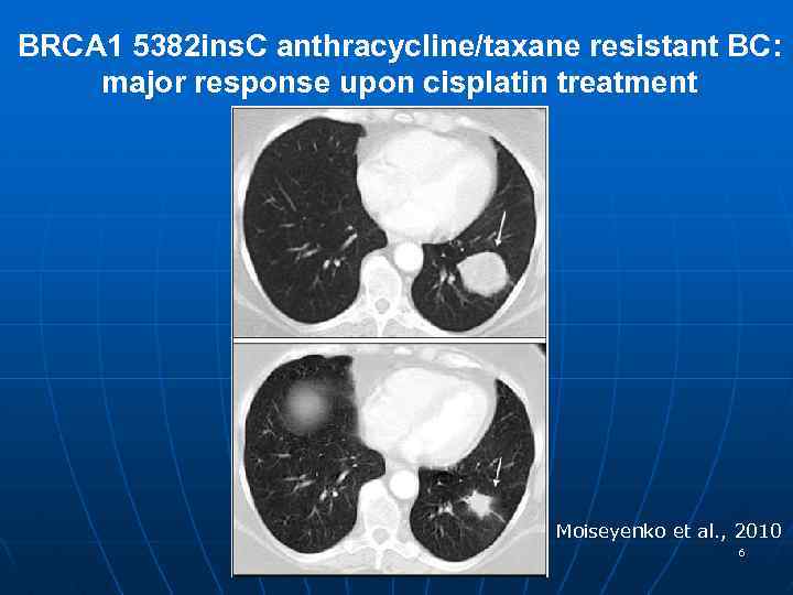 BRCA 1 5382 ins. C anthracycline/taxane resistant BC: major response upon cisplatin treatment Moiseyenko