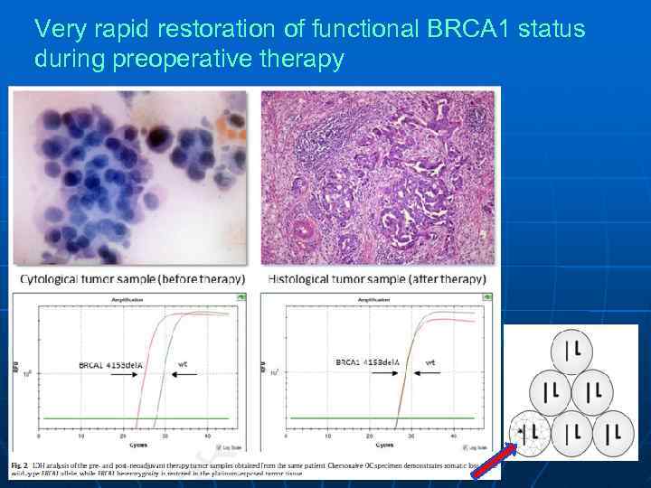 Very rapid restoration of functional BRCA 1 status during preoperative therapy 