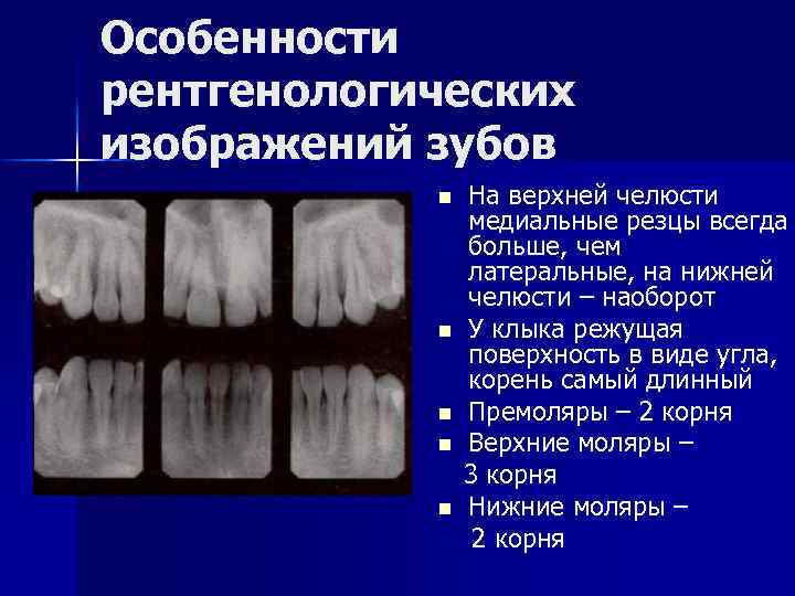 Особенности рентгенологических изображений зубов n n n На верхней челюсти медиальные резцы всегда больше,