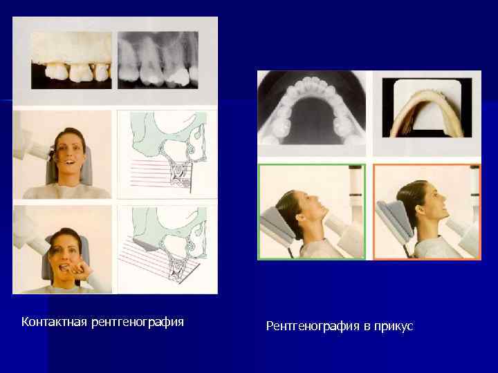 Контактная рентгенография Рентгенография в прикус 