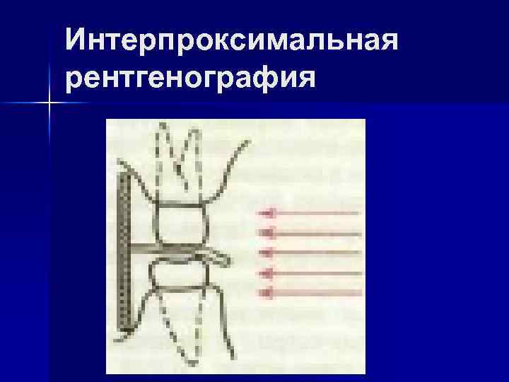 Интерпроксимальная рентгенография 