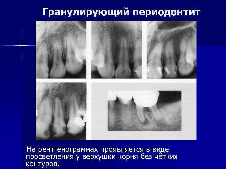 Гранулирующий периодонтит На рентгенограммах проявляется в виде просветления у верхушки корня без чётких контуров.