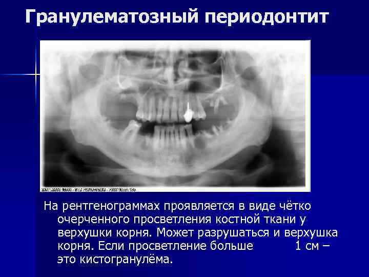 Гранулематозный периодонтит На рентгенограммах проявляется в виде чётко очерченного просветления костной ткани у верхушки