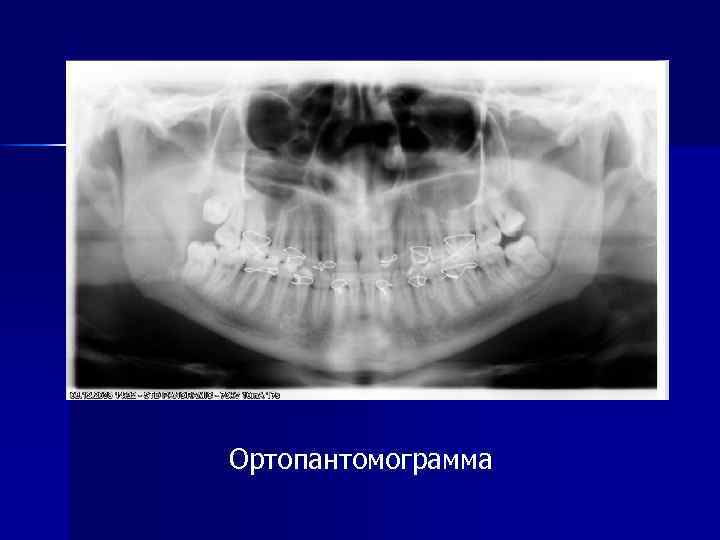 Ортопантомограмма 