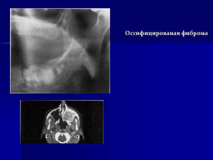 Оссифицированая фиброма 