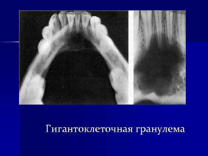 Гигантоклеточная гранулема 