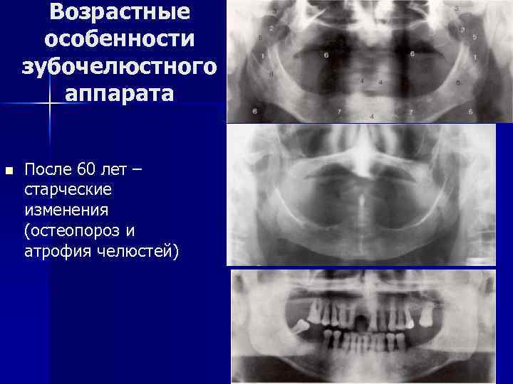 Возрастные особенности зубочелюстного аппарата n После 60 лет – старческие изменения (остеопороз и атрофия