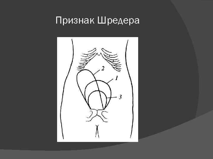 Признак Шредера 