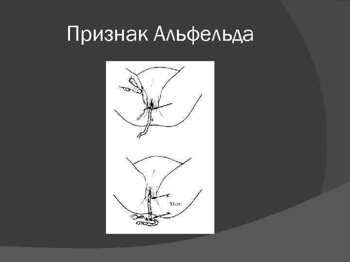 Признак Альфельда 