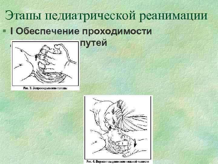 Этапы педиатрической реанимации § I Обеспечение проходимости дыхательных путей 