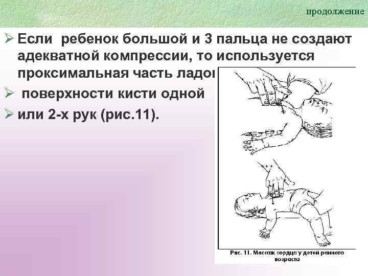 продолжение Ø Если ребенок большой и 3 пальца не создают адекватной компрессии, то используется