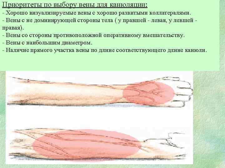 Приоритеты по выбору вены для канюляции: - Хорошо визуализируемые вены с хорошо развитыми коллатералями.