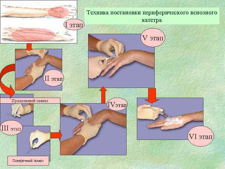 I этап Техника постановки периферического венозного катетра V этап II этап Продольный захват IVэтап