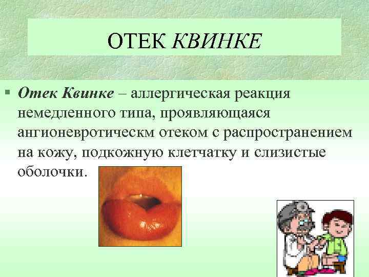 ОТЕК КВИНКЕ § Отек Квинке – аллергическая реакция немедленного типа, проявляющаяся ангионевротическм отеком с