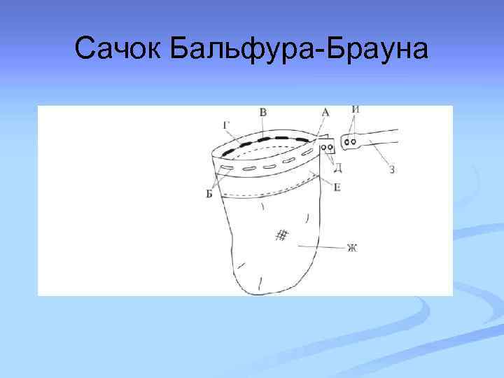 Сачок Бальфура-Брауна 