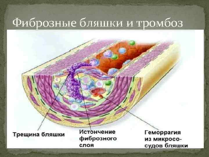 Фиброзные бляшки и тромбоз 