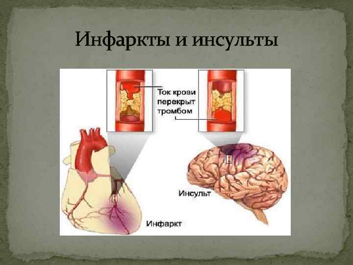 Инфаркты и инсульты 