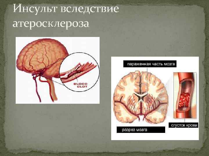 Инсульт вследствие атеросклероза 