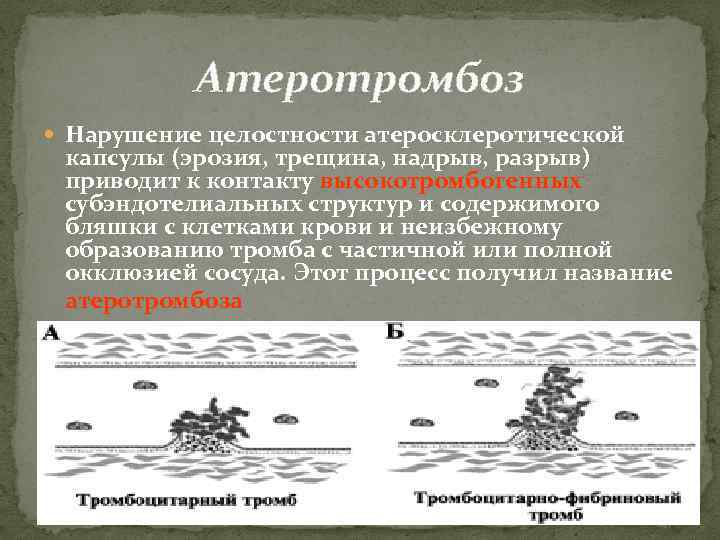 Атеротромбоз Нарушение целостности атеросклеротической капсулы (эрозия, трещина, надрыв, разрыв) приводит к контакту высокотромбогенных субэндотелиальных