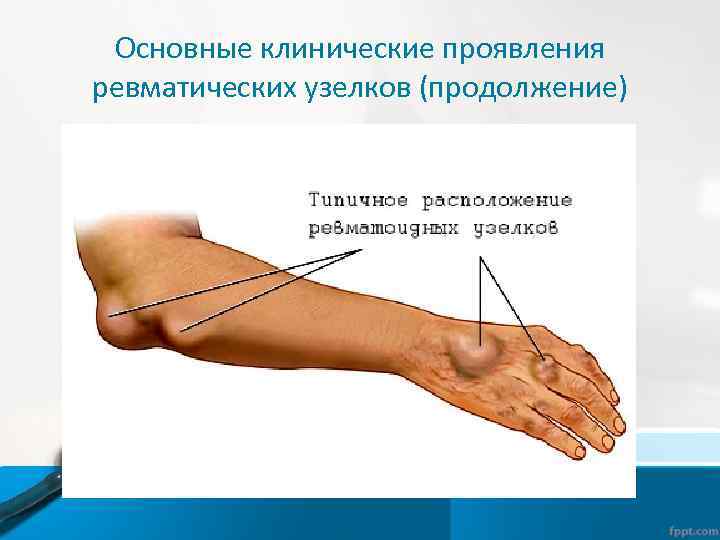 Основные клинические проявления ревматических узелков (продолжение) 