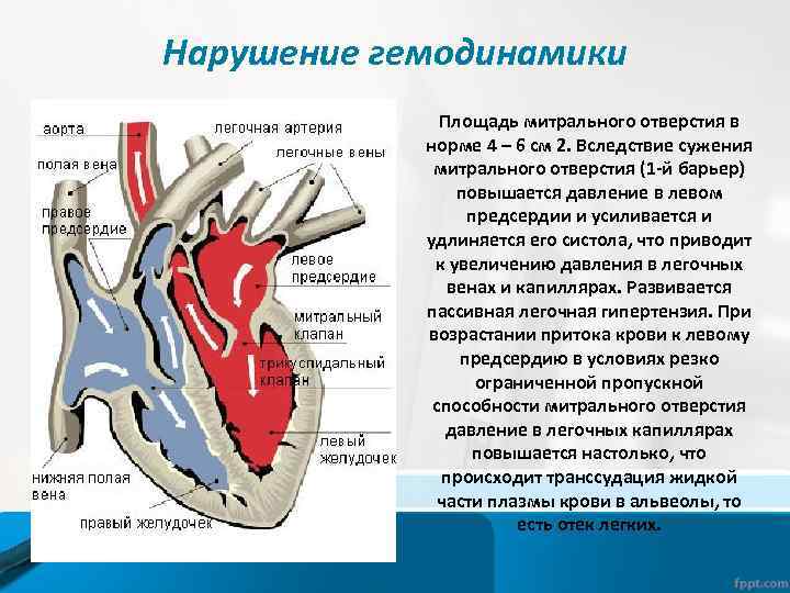 Нарушение гемодинамики Площадь митрального отверстия в норме 4 – 6 см 2. Вследствие сужения