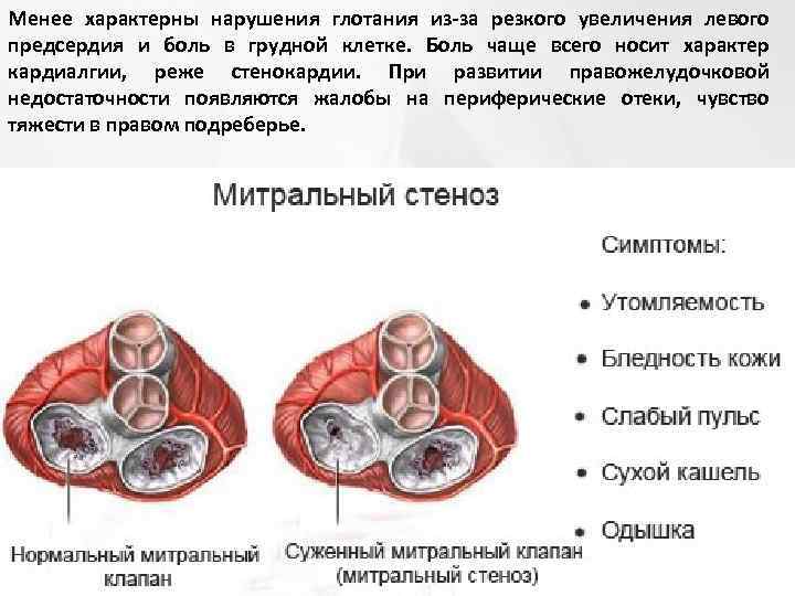 Поражение митрального клапана. Пороки сердца стеноз митрального клапана. Приобретенные пороки сердца митральный стеноз. Стеноз и недостаточность митрального клапана. Пороки митрального клапана стеноз.