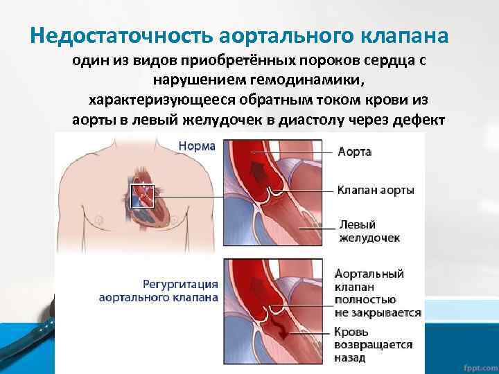 Недостаточность аортального клапана один из видов приобретённых пороков сердца с нарушением гемодинамики, характеризующееся обратным