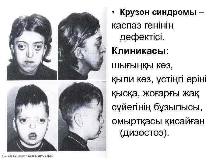  • Крузон синдромы – каспаз генінің дефектісі. Клиникасы: шығыңқы көз, қыли көз, үстіңгі