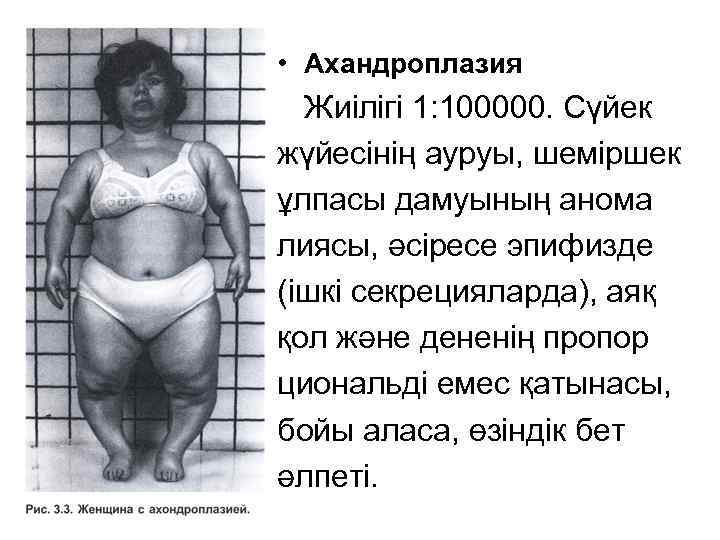  • Ахандроплазия Жиілігі 1: 100000. Сүйек жүйесінің ауруы, шеміршек ұлпасы дамуының анома лиясы,