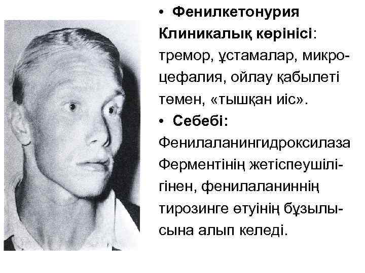  • Фенилкетонурия Клиникалық көрінісі: тремор, ұстамалар, микроцефалия, ойлау қабылеті төмен, «тышқан иіс» .