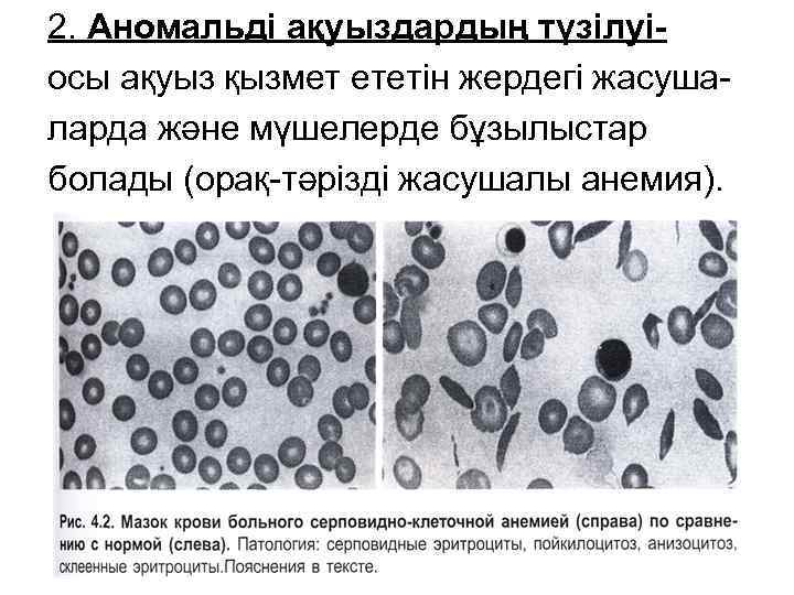 2. Аномальді ақуыздардың түзілуіосы ақуыз қызмет ететін жердегі жасушаларда және мүшелерде бұзылыстар болады (орақ-тәрізді