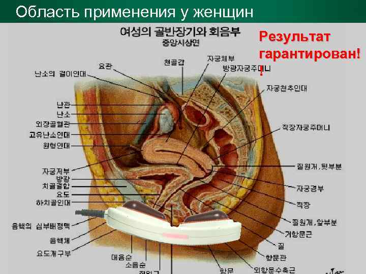 Область применения у женщин Результат гарантирован! ! 