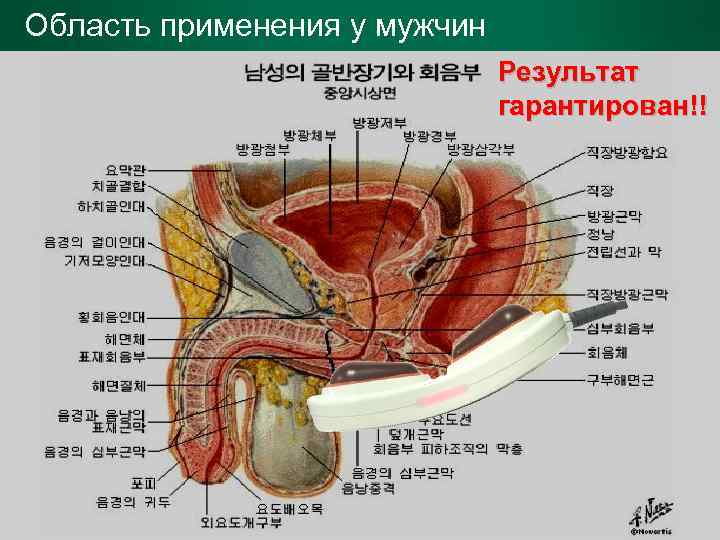 Область применения у мужчин Результат гарантирован!! 