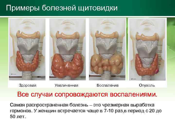 Примеры болезней щитовидки Здоровая Увеличенная Воспаление Опухоль Все случаи сопровождаются воспалениями. Самая распространенная болезнь