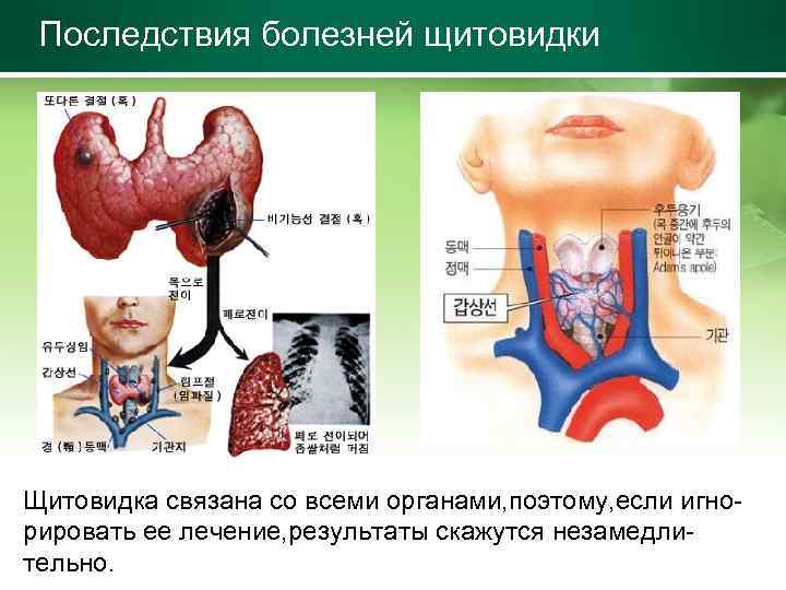 Последствия болезней щитовидки Щитовидка связана со всеми органами, поэтому, если игнорировать ее лечение, результаты