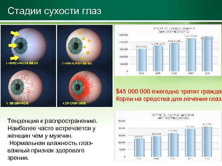 Стадии сухости глаз $45 000 ежегодно тратят граждан Кореи на средства для лечения глаз.