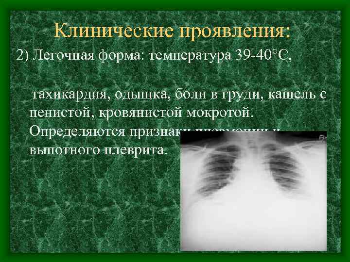 Клинические проявления: 2) Легочная форма: температура 39 -40°C, тахикардия, одышка, боли в груди, кашель