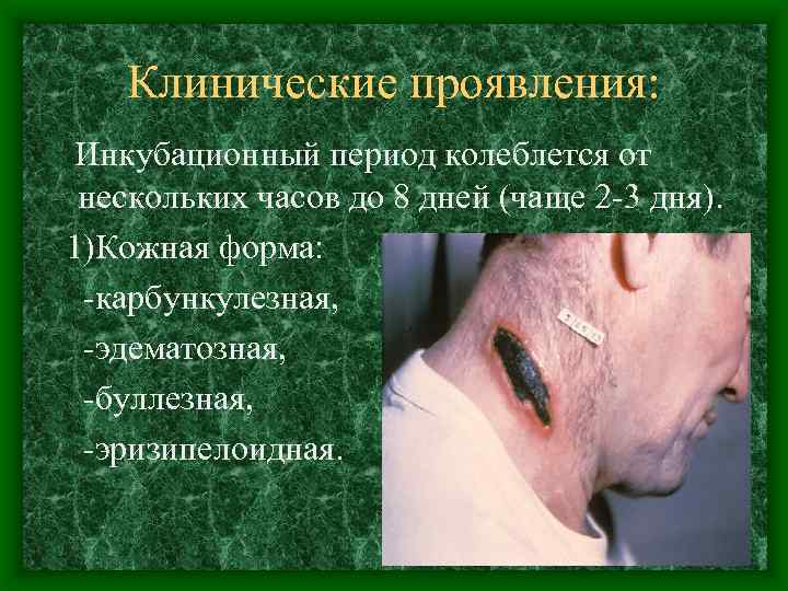 Клинические проявления: Инкубационный период колеблется от нескольких часов до 8 дней (чаще 2 -3