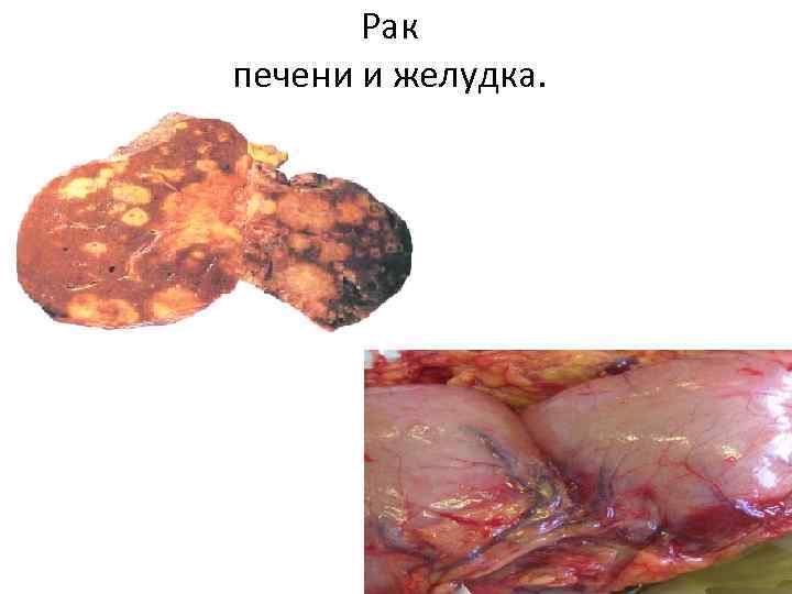 Рак печени и желудка. 