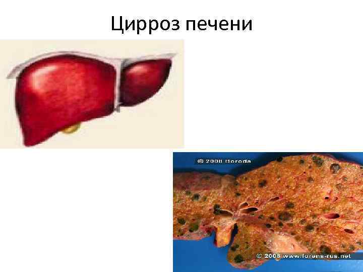 Цирроз печени 