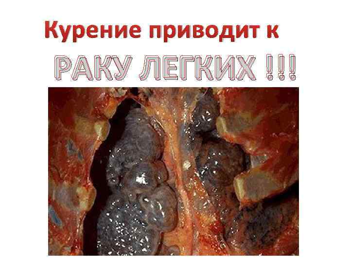 Курение приводит к РАКУ ЛЕГКИХ !!! 