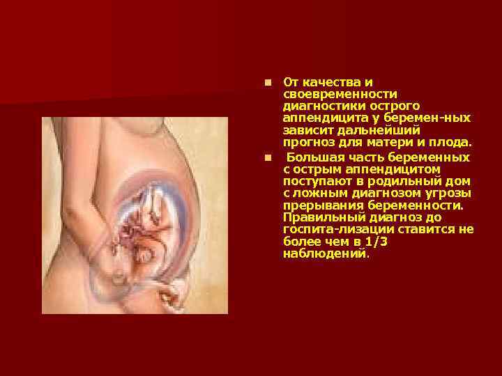 От качества и своевременности диагностики острого аппендицита у беремен ных зависит дальнейший прогноз для
