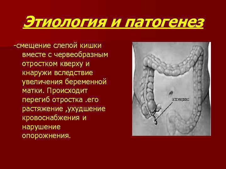 Этиология и патогенез смещение слепой кишки вместе с червеобразным отростком кверху и кнаружи вследствие