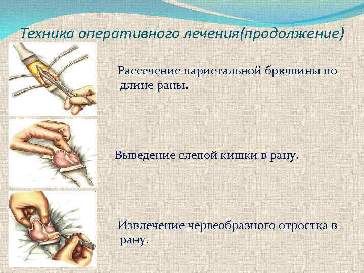 Техника оперативного лечения(продолжение) Рассечение париетальной брюшины по длине раны. Выведение слепой кишки в рану.