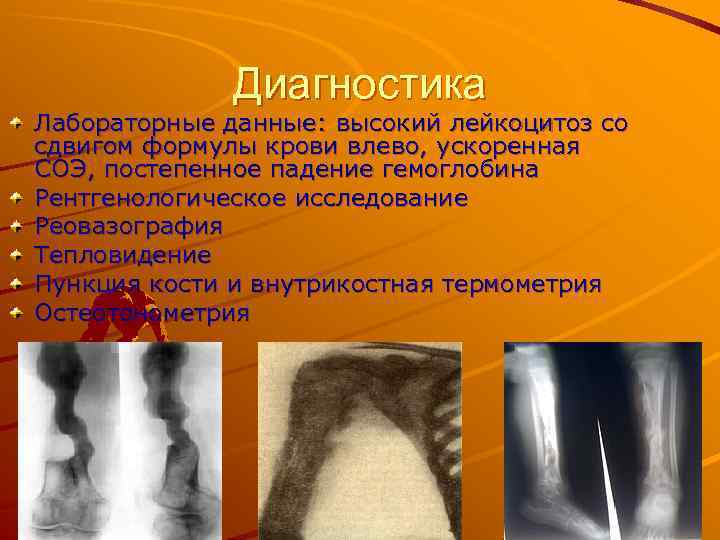Диагностика Лабораторные данные: высокий лейкоцитоз со сдвигом формулы крови влево, ускоренная СОЭ, постепенное падение