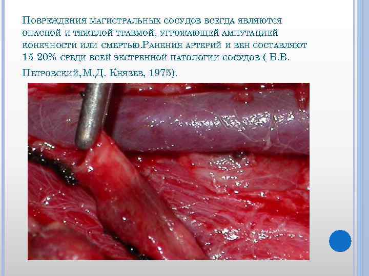 ПОВРЕЖДЕНИЯ МАГИСТРАЛЬНЫХ СОСУДОВ ВСЕГДА ЯВЛЯЮТСЯ ОПАСНОЙ И ТЯЖЕЛОЙ ТРАВМОЙ, УГРОЖАЮЩЕЙ АМПУТАЦИЕЙ КОНЕЧНОСТИ ИЛИ СМЕРТЬЮ.