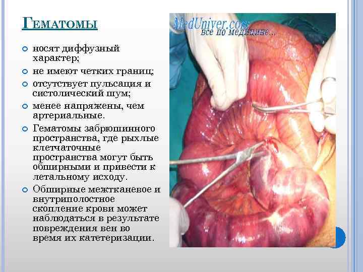 ГЕМАТОМЫ носят диффузный характер; не имеют четких границ; отсутствует пульсация и систолический шум; менее