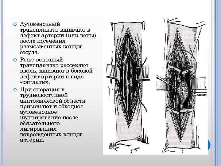  Аутовенозный трансплантат вшивают в дефект артерии (или вены) после иссечения размозженных концов сосуда.